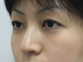 目の下のクマ・タルミ症例手術３ヶ月後