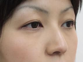 目の下のクマ・タルミ症例手術前