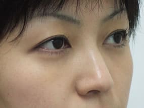 目の下のクマ・タルミ症例手術３ヶ月後