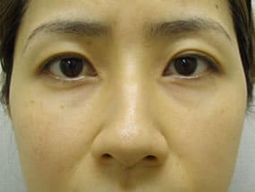 目の下のクマ・タルミ症例手術前