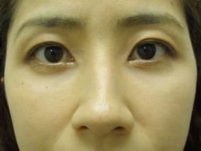 目の下のクマ・タルミ症例手術３ヶ月後