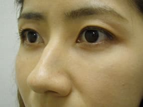 目の下のクマ・タルミ症例手術３ヶ月後