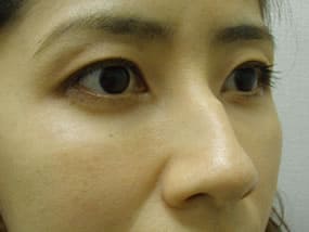 目の下のクマ・タルミ症例手術３ヶ月後