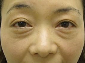 目の下のクマ・タルミ症例手術前