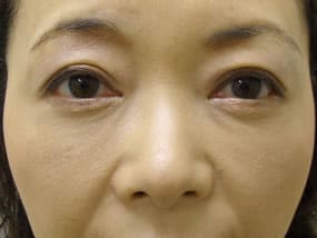 目の下のクマ・タルミ症例手術３ヶ月後