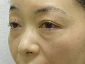 目の下のクマ・タルミ症例手術前