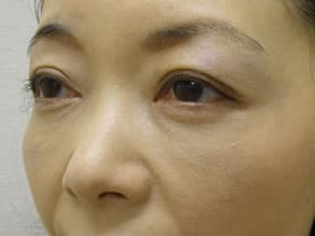 目の下のクマ・タルミ症例手術３ヶ月後