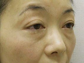 目の下のクマ・タルミ症例手術前