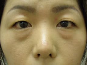目の下のクマ・タルミ症例手術前
