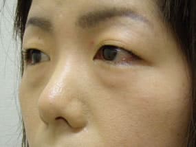 目の下のクマ・タルミ症例手術前