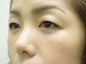 目の下のクマ・タルミ症例手術３ヶ月後