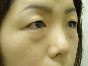 目の下のクマ・タルミ症例手術前