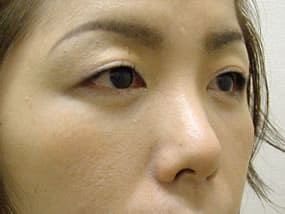 目の下のクマ・タルミ症例手術３ヶ月後