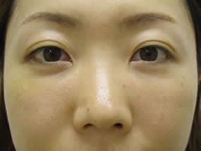目の下のクマ・タルミ症例手術１週間後（メイクあり）