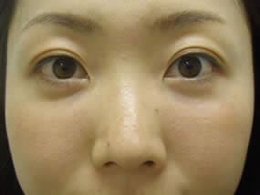目の下のクマ・タルミ症例手術２週間後（メイクあり）