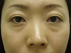 目の下のクマ・タルミ症例手術前