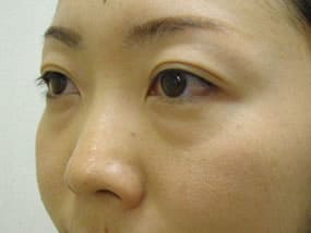 目の下のクマ・タルミ症例手術前