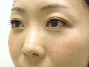 目の下のクマ・タルミ症例手術３ヶ月後