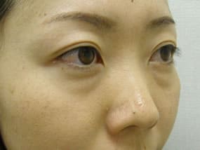 目の下のクマ・タルミ症例手術前