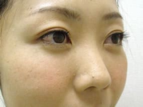 目の下のクマ・タルミ症例手術３ヶ月後