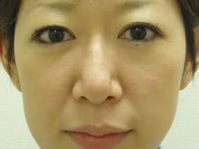 目の下のクマ・タルミ症例手術前