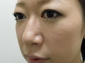 目の下のクマ・タルミ症例手術３ヶ月後