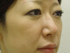 目の下のクマ・タルミ症例手術前