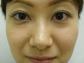 目の下のクマ・タルミ症例手術前