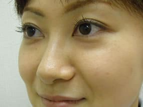 目の下のクマ・タルミ症例手術前
