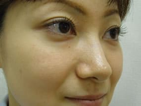 目の下のクマ・タルミ症例手術前
