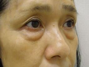 目の下のクマ・タルミ症例手術前