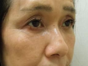 目の下のクマ・タルミ症例手術３ヶ月後