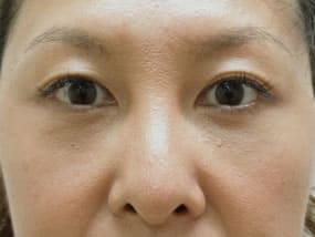 目の下のクマ・タルミ症例手術３ヶ月後