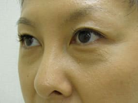 目の下のクマ・タルミ症例手術前