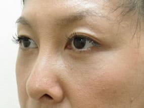 目の下のクマ・タルミ症例手術３ヶ月後
