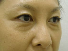 目の下のクマ・タルミ症例手術前