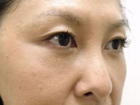 目の下のクマ・タルミ症例手術３ヶ月後