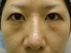 目の下のクマ・タルミ症例手術前