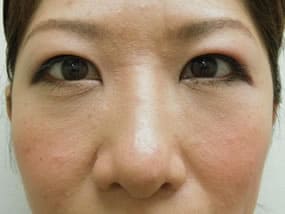 目の下のクマ・タルミ症例手術３ヶ月後