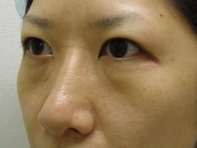 目の下のクマ・タルミ症例手術前