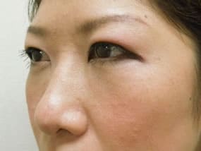 目の下のクマ・タルミ症例手術３ヶ月後