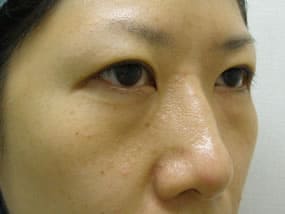 目の下のクマ・タルミ症例手術前