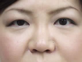目の下のクマ・タルミ症例手術前（メイクあり）