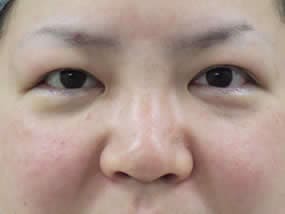 目の下のクマ・タルミ症例手術直後（メイクなし）