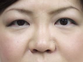 目の下のクマ・タルミ症例手術前