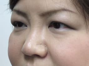 目の下のクマ・タルミ症例手術前