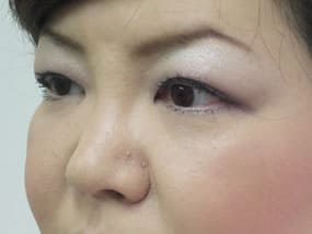 目の下のクマ・タルミ症例手術３ヶ月後