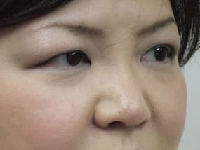 目の下のクマ・タルミ症例手術前