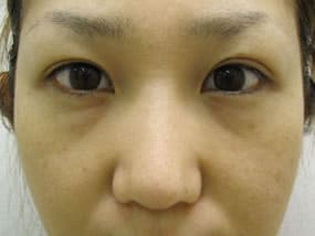 目の下のクマ・タルミ症例手術前