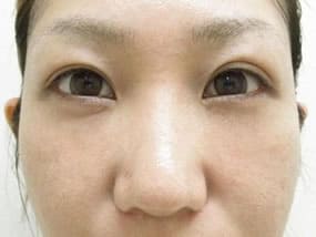 目の下のクマ・タルミ症例手術３ヶ月後